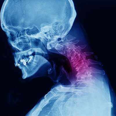 Seniors need to safeguard against cervical spondylotic myelopathy